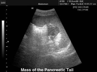 Pancreatic tail mass, B-mode