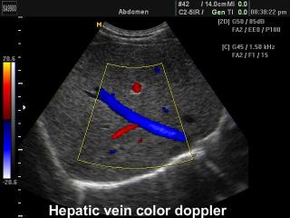 Hepatic vein, color doppler