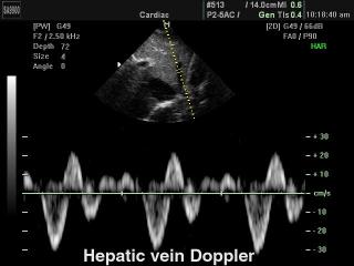 Hepatic vein, PW