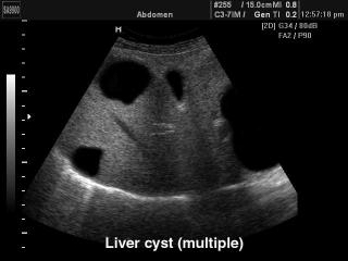 Liver polycystic, B-mode