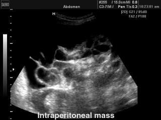 Intestines - intraperitoneal induration, B-mode.