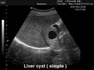 Liver - simple cyst, B-mode
