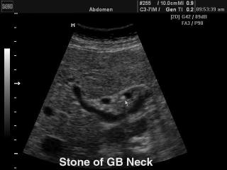 Stone in the neck of gallbladde, B-mode
