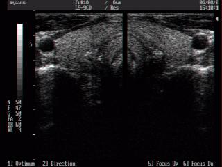 Thyroid, B-mode