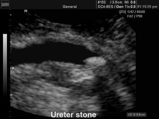 Ureter stone, B-mode