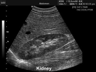 Kidney, B-mode