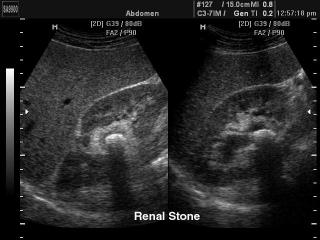 Renal stone, B-mode