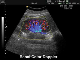 Kidney, color doppler