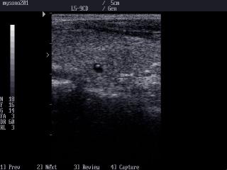 Thyroid cyst, B-mode