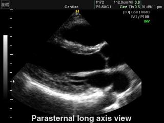 Heart (long axis of LV), B-mode