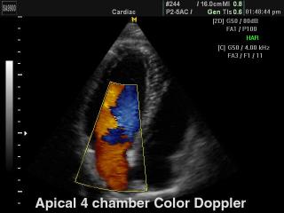 Heart (4 chamber view), color doppler