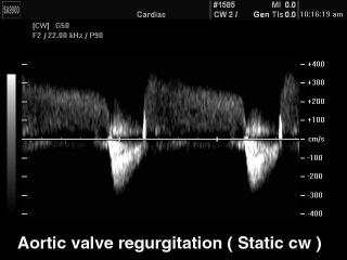 Aortic valve regurgitation, CW