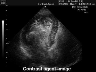 Heart - contrast echography, B-mode