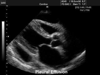 Pleural effusion, B-mode