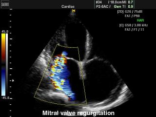 Mitral valve regurgitation, color doppler