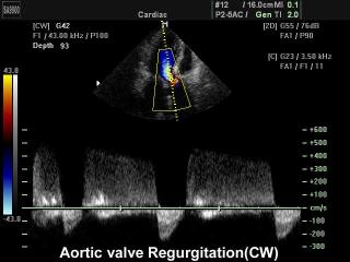 Aortic valve regurgitation, CFM & CW