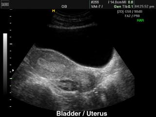 Uterrus and bladder, B-mode