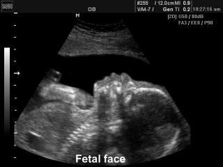 Fetal face, B-mode