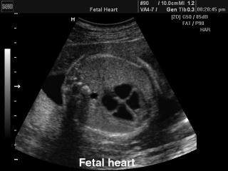 Fetal heart, B-mode