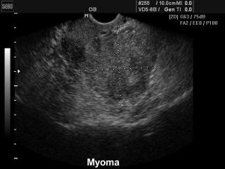 Uterine myoma, B-mode