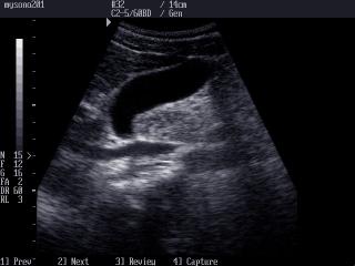 Gall bladder, B-mode