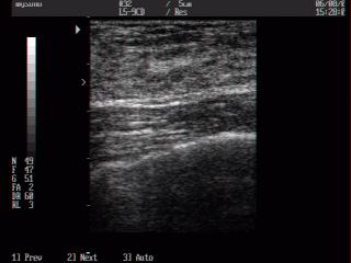 Breast - norm, B-mode