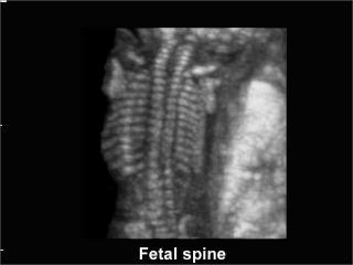 Fetal spine, B-mode