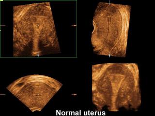 Uterus - norm, 3D