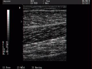 Gastrocnemius muscle, B-mode