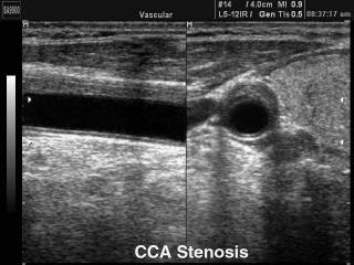 Common carotid artery stennosis, B-mode