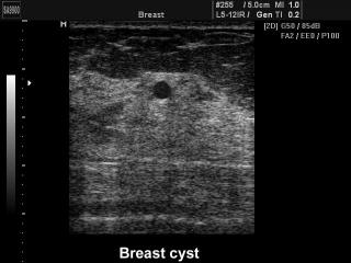 Breast cyst, B-mode