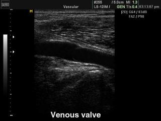 Venous valve, B-mode