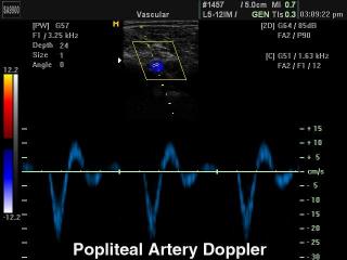 Popliteal artery and vein, CFM & PW