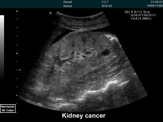 Kidney cancer, B-mode
