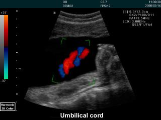 Umbilical cord, color doppler