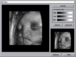 Fetal face, 3D View