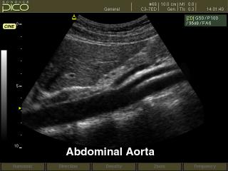 Abdominal aorta, B-mode