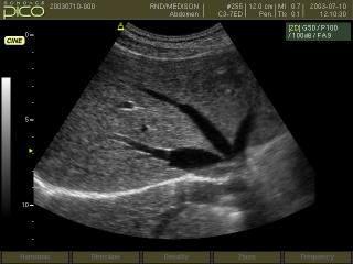 Hepatic vein, B-mode