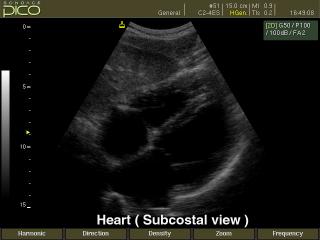 Heart (subcostal view), B-mode