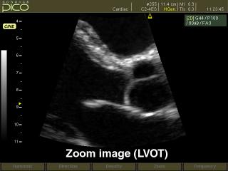 Left ventrical - outflow track, B-mode