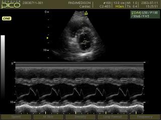 Mitral valve, M-mode