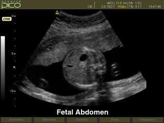 Fetal abdomen, B-mode