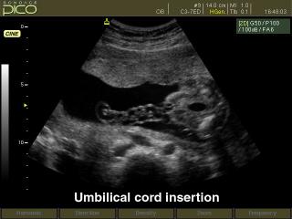 Umbilical cord insertion, B-mode