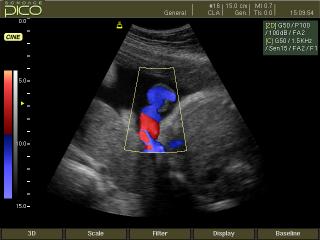 Umbilical cord, color doppler