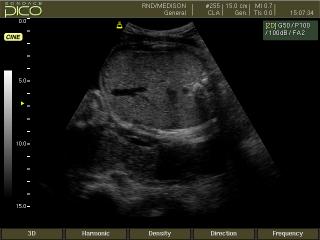Fetal abdomen, B-mode