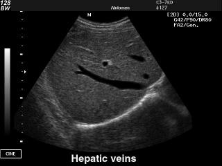Hepatic veins, B-mode