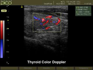 Thyroid, color doppler