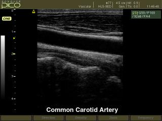 Common carotid artery, B-mode