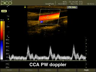 Common carotid artery, CFM & PW