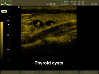 Thyroid cyst, B-mode